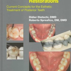 Adhesive Metal-Free Restorations