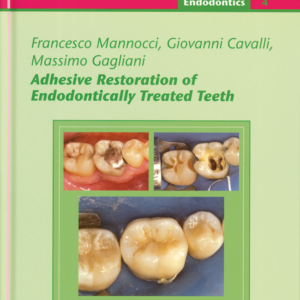 Adhesive Restoration Of Endodontically Treated Teeth