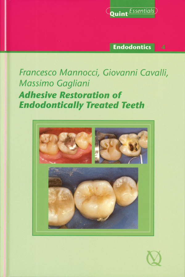 Adhesive Restoration Of Endodontically Treated Teeth