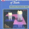 Autotransplantation Of Teeth