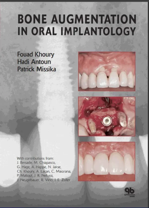 Bone Augmentation In Oral Implantology